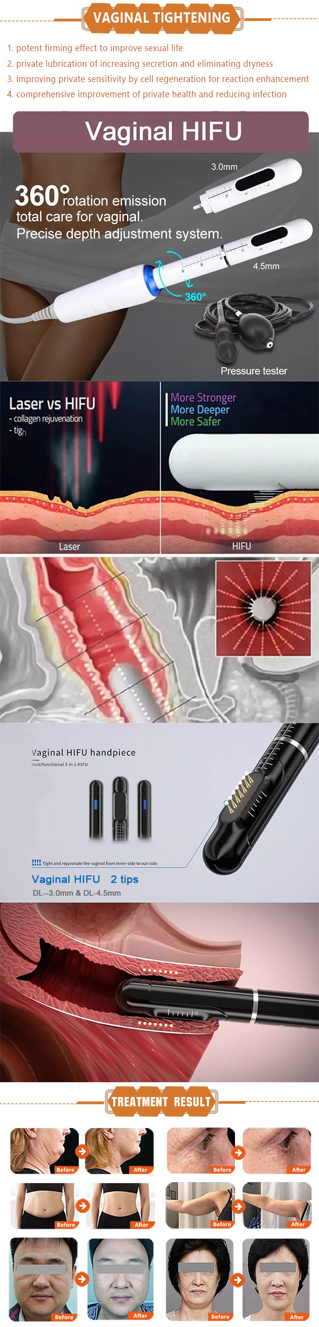 25mm Handheld Hifu Machine 3D Ultrasound Skin Tightening For Home Use
