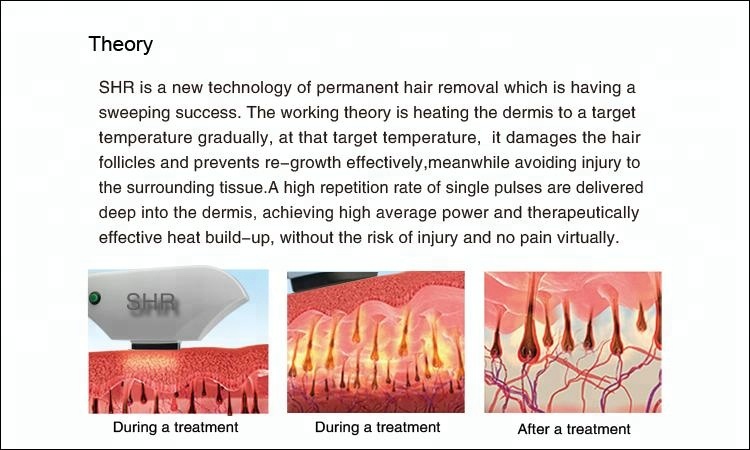 CE DPL Laser Machine Skin Rejuvenation Acne Pigmentation Treatment Machine