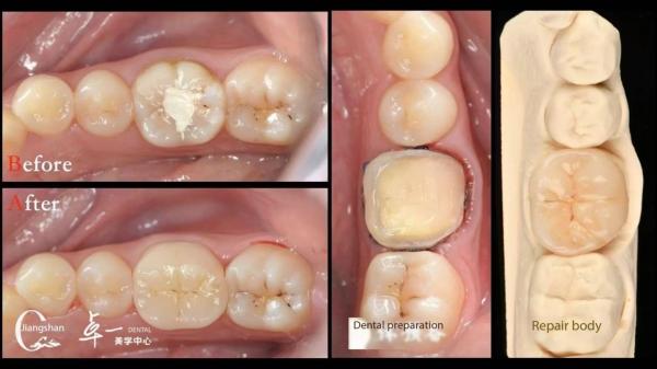 Biocompatibility And High Compatibility With Natural Teeth Restoration Dental