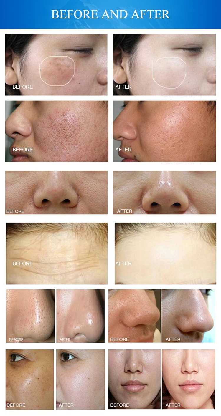 Microdermabrasion Beauty 10 In 1 Hydrafacial Machine Skin Peel Device