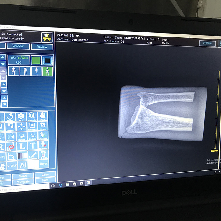 Best Sell Portable X-ray Machine Digital Digital Portable X Ray Machine