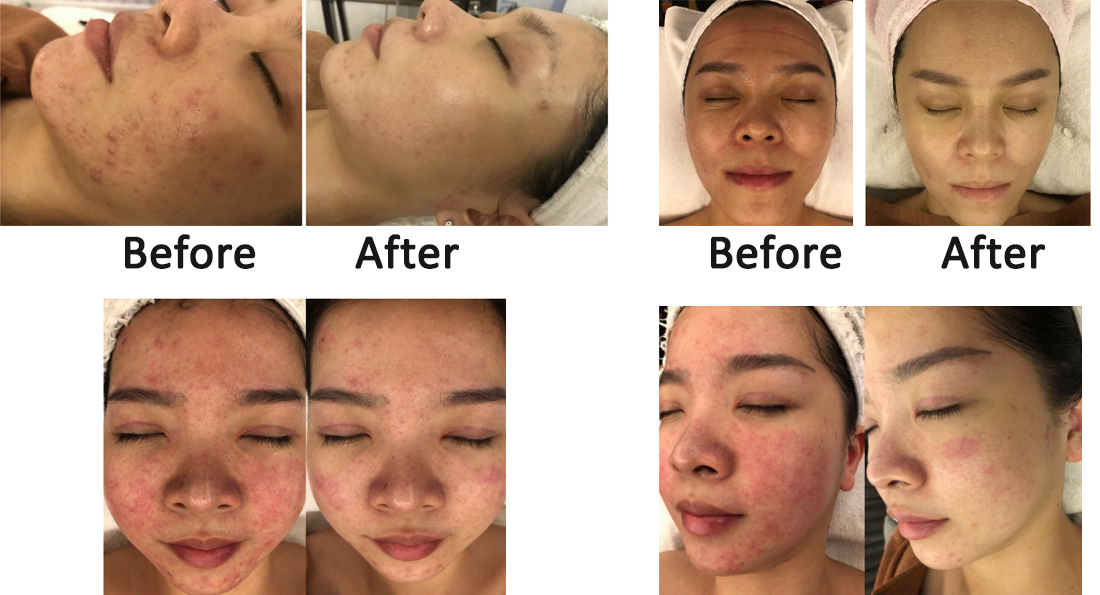 Needless RF Meso Machine Anti Aging Mesotherapy Machine For Face