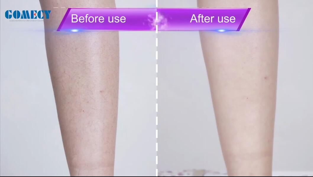diode laser 808nm 810nm remove undesired hairs permanently.jpg