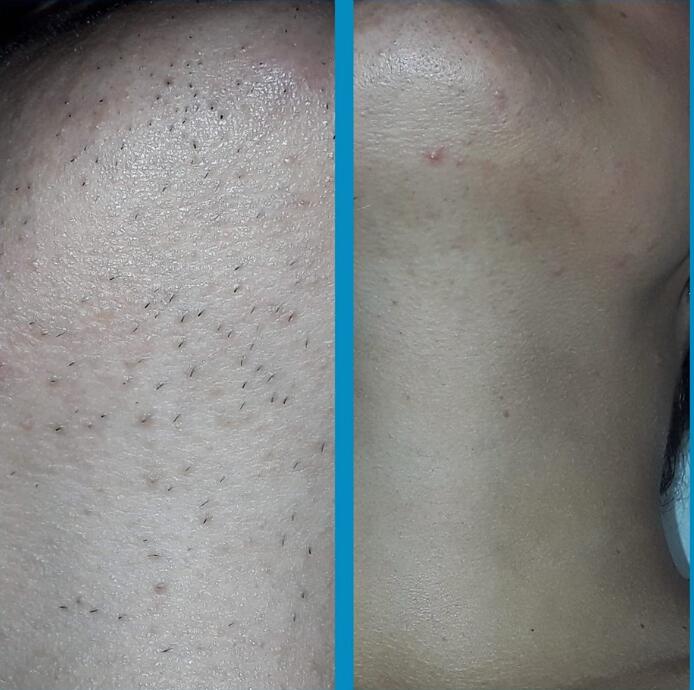 Professional Portable Hair Removal Laser Machine For Salon / Home