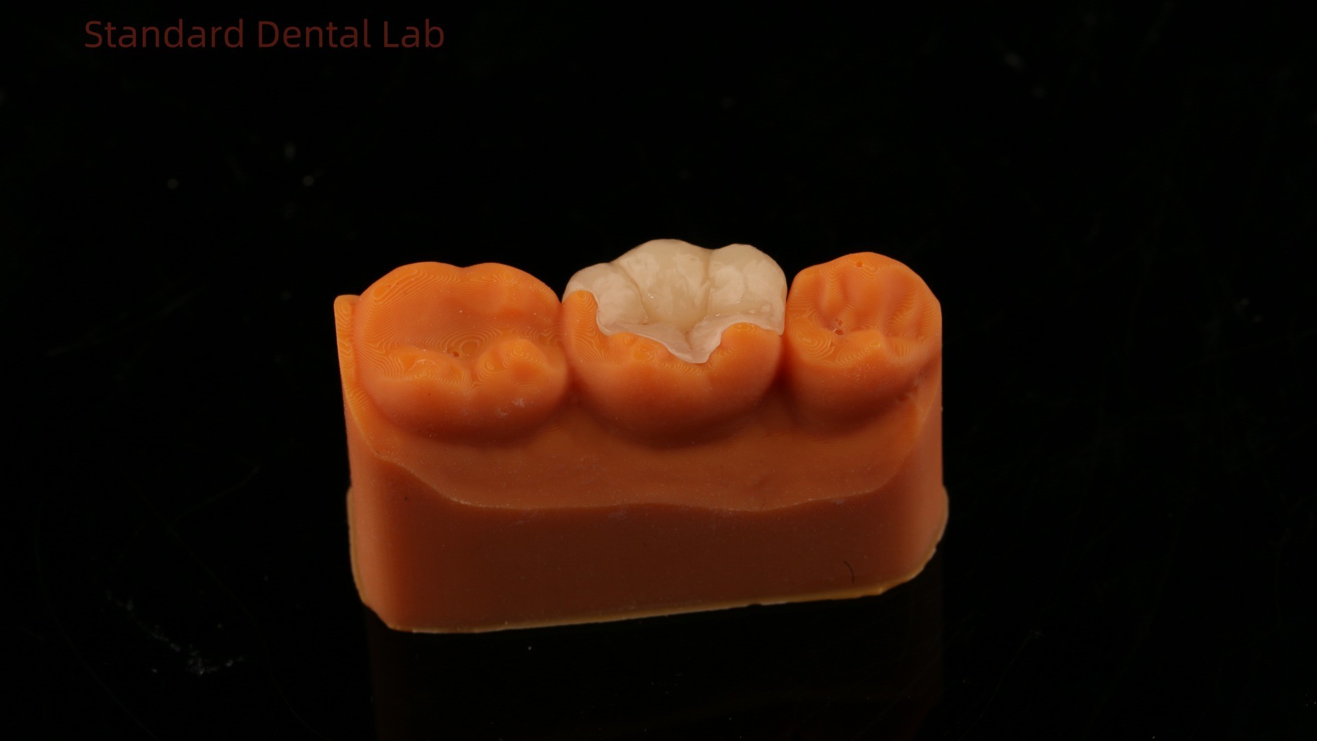 Strength Emax Ceramic Crown Dental Onlay with Excellent Stain Resistance China Dental Lab