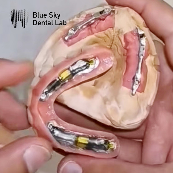Titanium Dental Locator With Removable Denture And Ball Cap Attachments