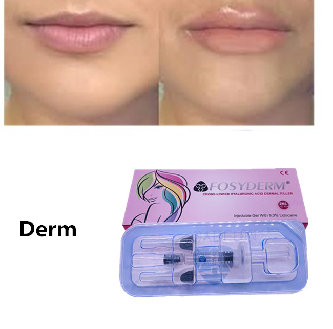 Long Lasting Fosyderm Hyaluronic Acid Dermal Filler For Cosmetic Injection