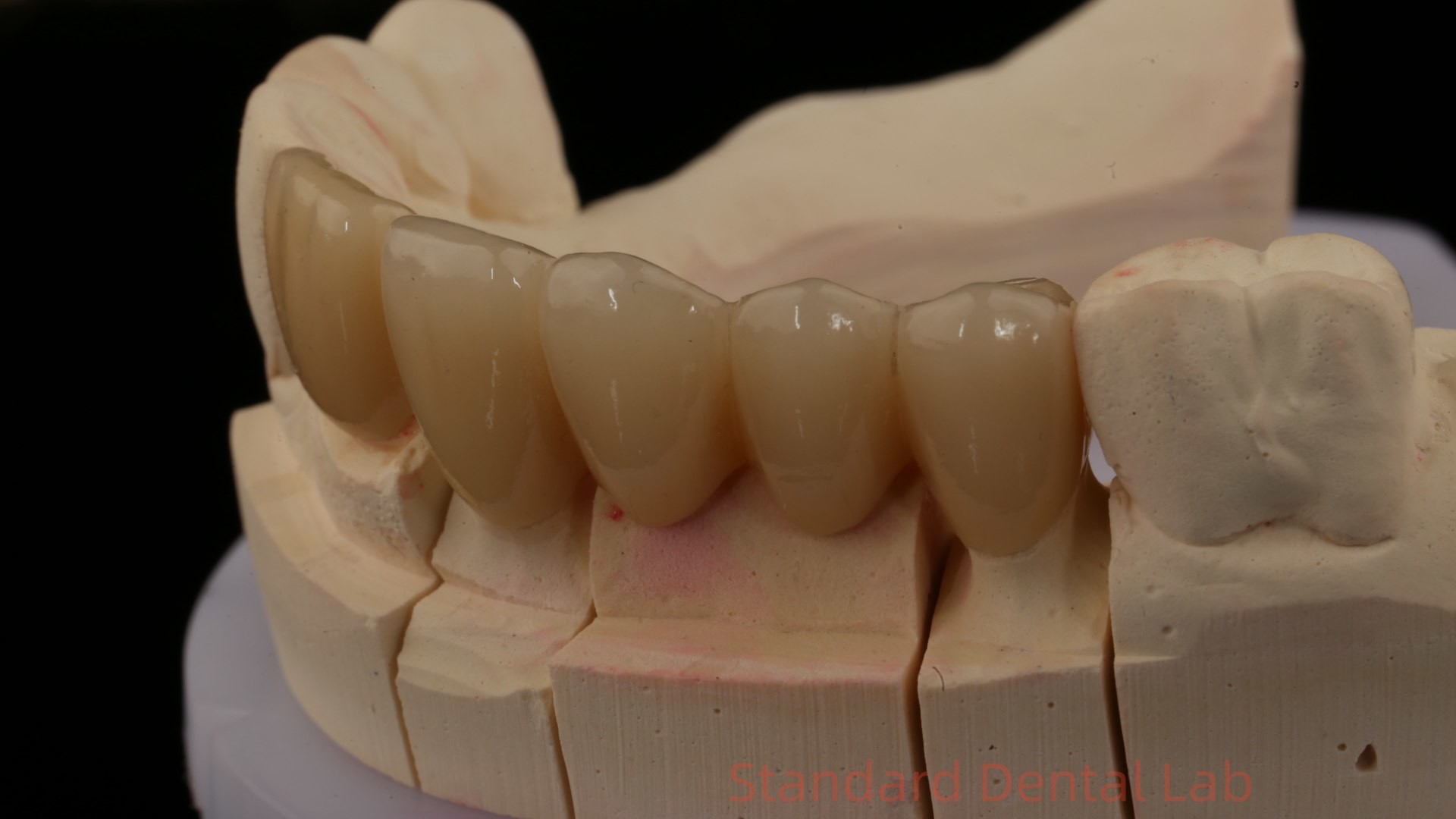 Noritake Porcelian Full Contour Zirconia Crown High Aesthetic Natural Customized Zirconia Dental Bridge