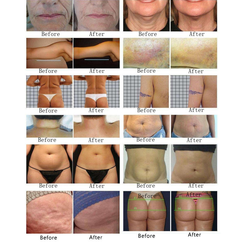 4 In1 808NM Hair Removal Diode Laser Tattoo Removal Q Switched Nd Yag Laser IPL 755 808 1064nm Machine