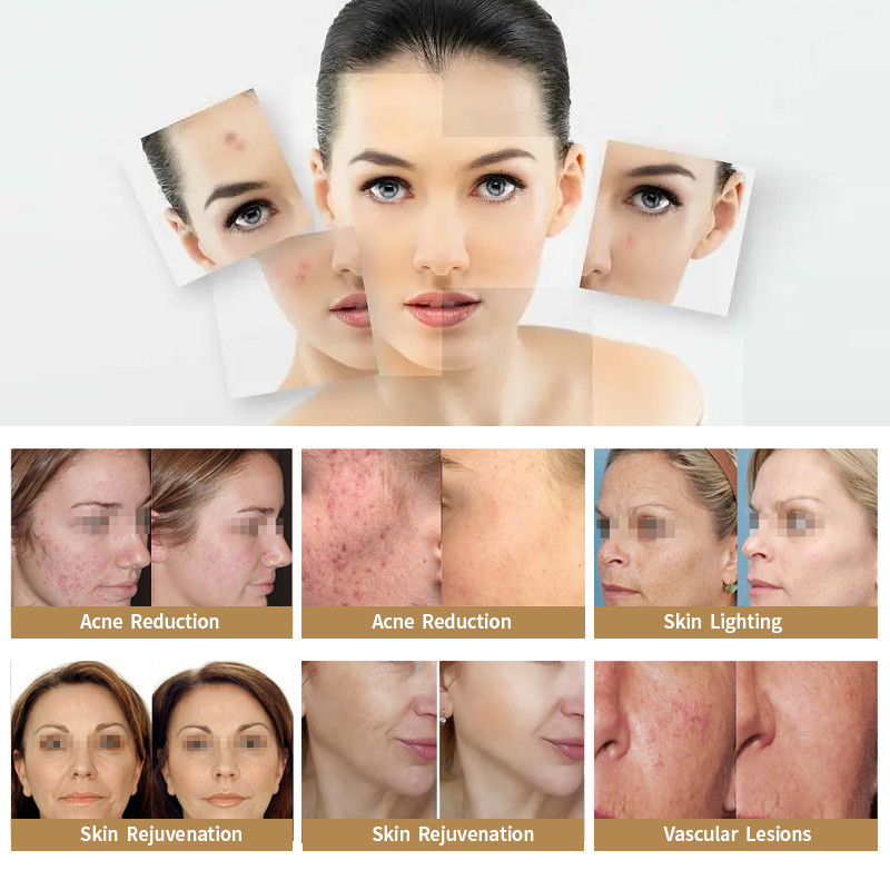 Professional Ipl Shr Laser Opt Skin Rejuvenation 15x15mm Spot Size