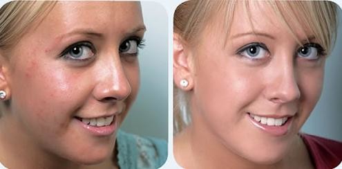 cpt skin rejuvenation machine fractional microneedle radiofrequency