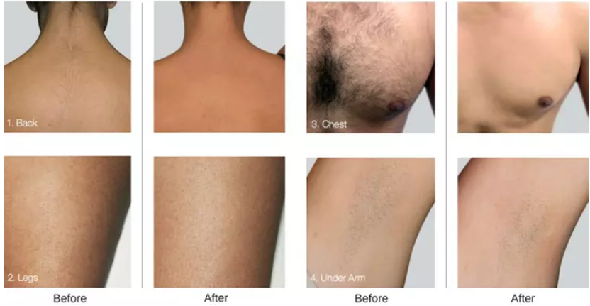 808 Laser Beauty Equipment Diode Painless Fast Hair Removal Machine