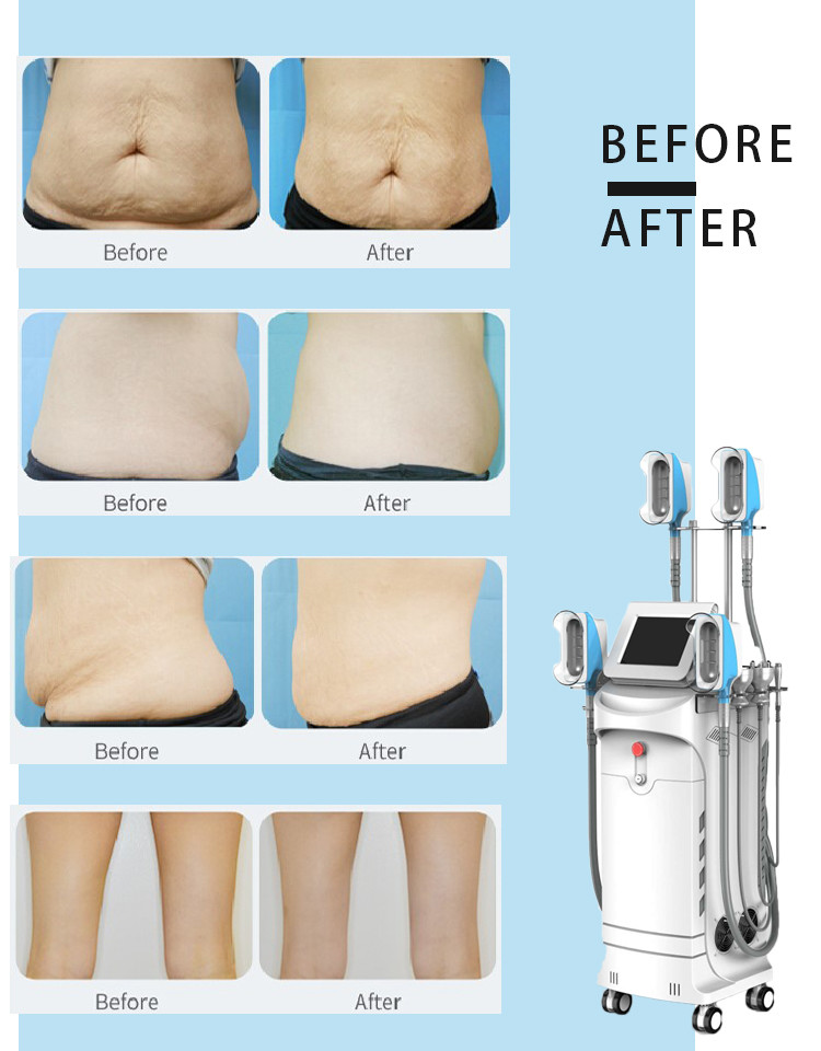 LF-265A 5 Cryo Handles 360 Cryolipolysis vacuum cavitation rf lipo laser Slimming Machine with Reduce Double Chin handle