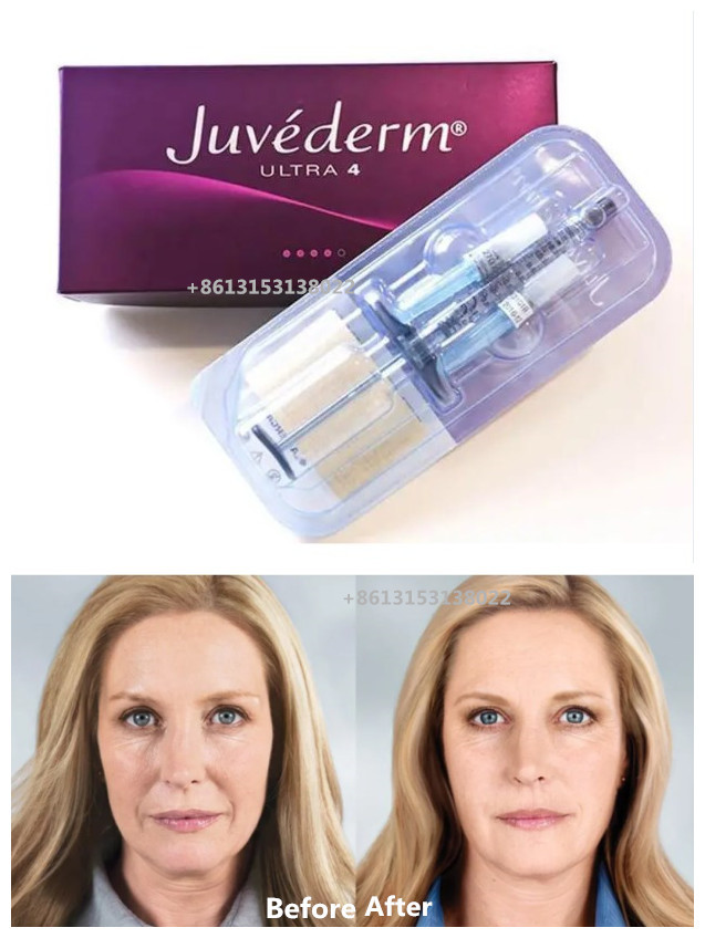 Juvederm Dermal Filler Juvederm Ultra4 HA Dermal Filler Juvederm Voluma