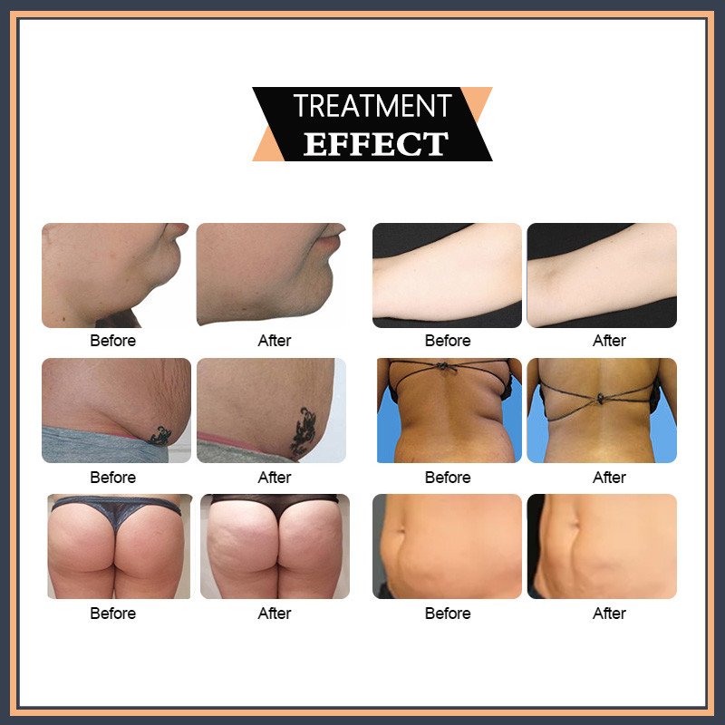 Laser Lipolysis Lipolaser Slimming Machine 6D 532nm 635nm 600W