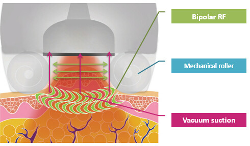 Ultrasonic Cavitation Body Vacuum Slimming Machine 25m3/H Output Improves Skin Texture