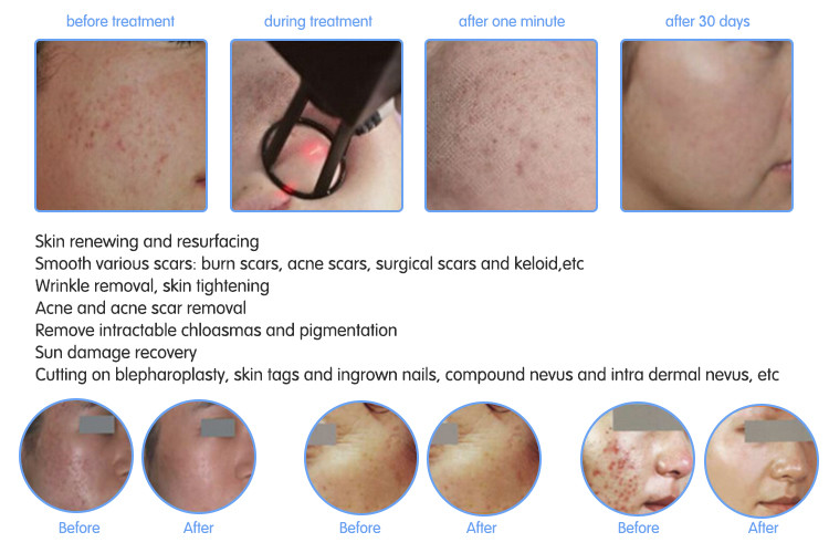 Professional fractional co2 laser Wrinkle Removal medical laser system machines