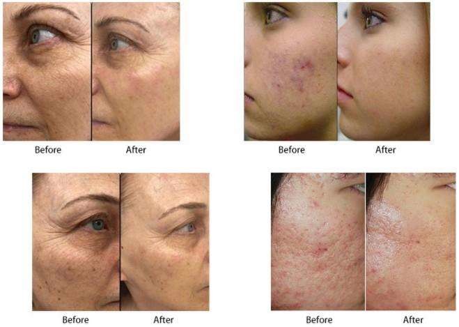 Fractional Micro Needle RF Stretch Mark Laser Removal Machine