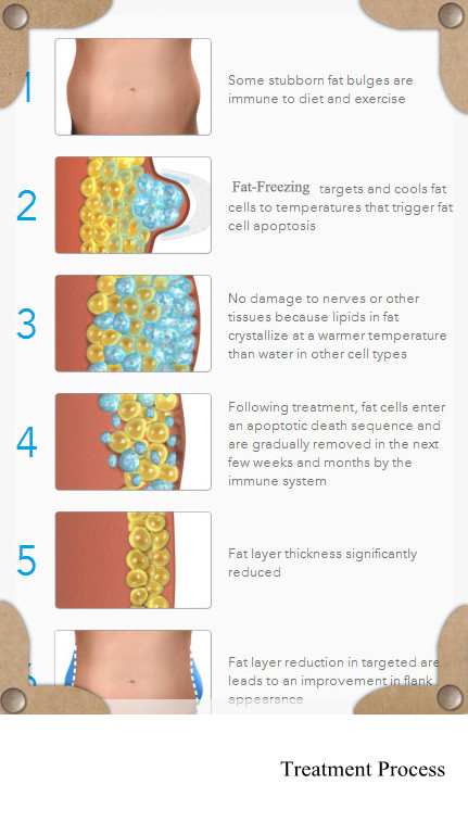 2016 the best cryotherapy machine for weight loss and body slimming
