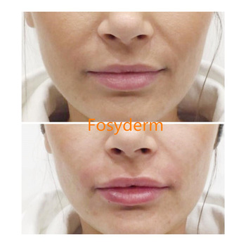 1ml Deep Wrinkles Hyaluronic Acid Injection Dermal Filler Cross Linked