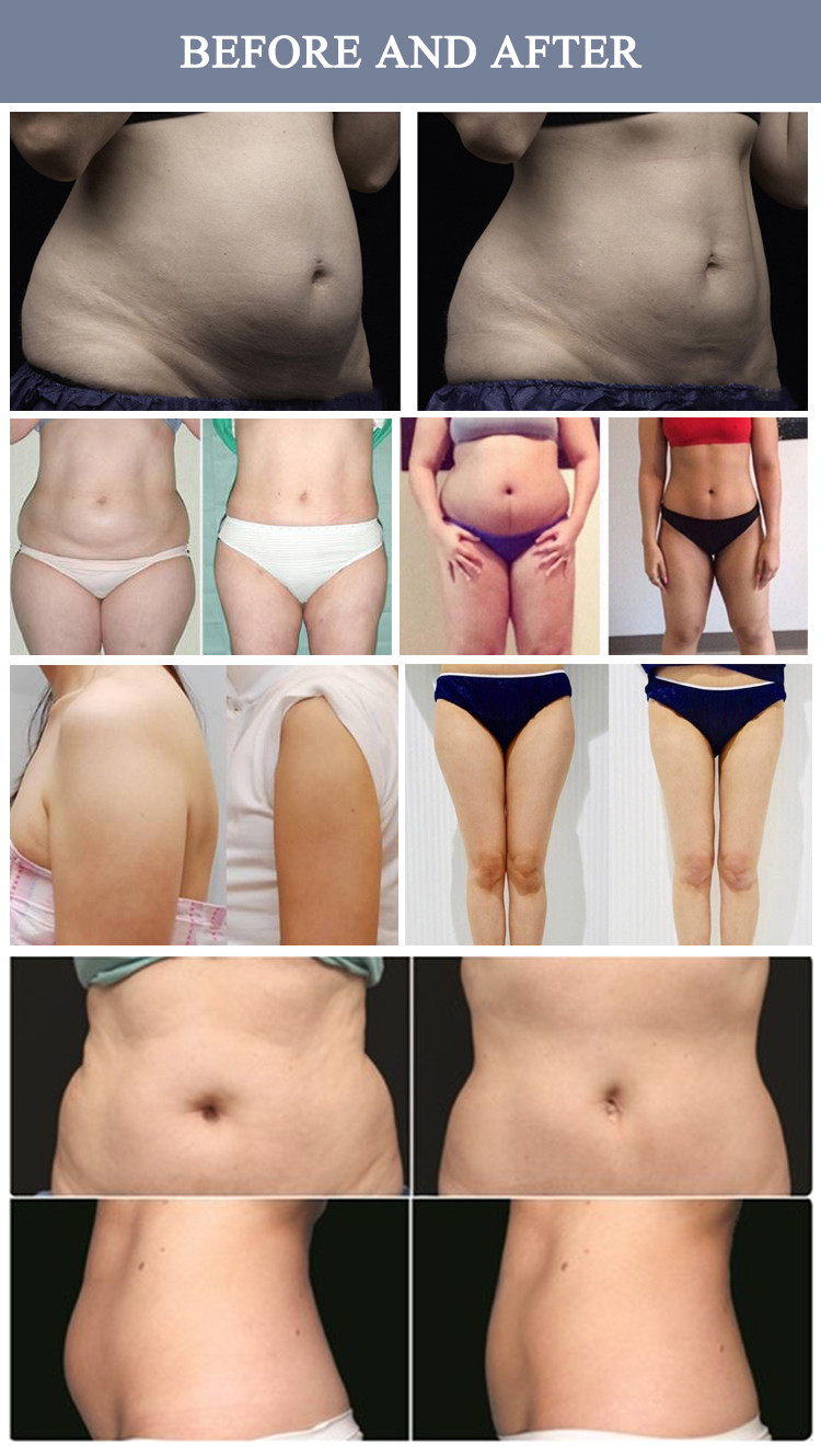 Anti Cellulite Lipo Laser Slimming Machine For Fat Loss No Recovery Period OEM
