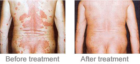 Phillip Uvb Lamp Comb Uv Light Therapy For Psoriasis / Vitiligo Treatment