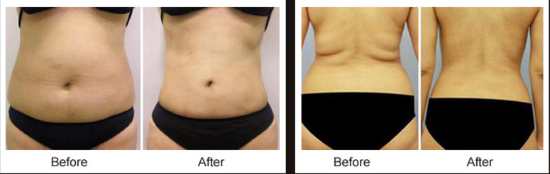 Surgical Diode Laser Lipo Machine / Body Contouring Machine For Cellulite Reduction
