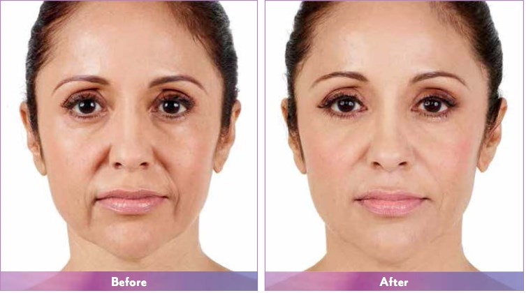 Juvederm Voluma Hyaluronic Acid Dermal Filler Prefilled Injection Gel
