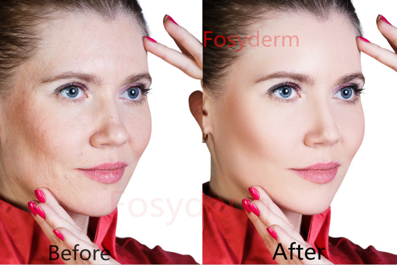 HA Injectable Dermal Facial Filler , Hyaluronic Acid injection Filler with Lidocaine