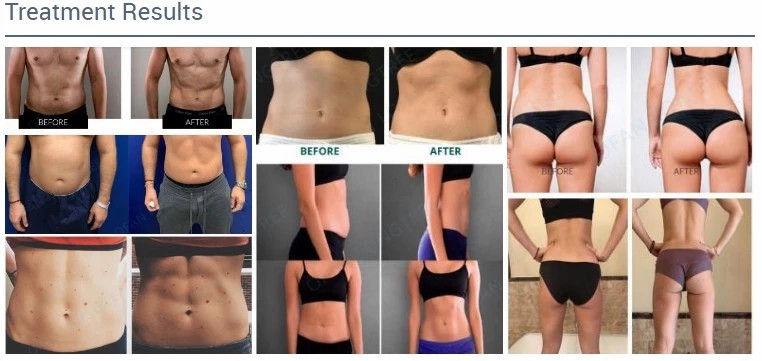 Toning Hips Tesla Sculptor Magnetic Body Sculpting Machine 4 Handles