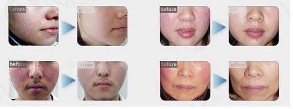 Varicose veins laser treatment machine spider veins on face removal vein removal in legs