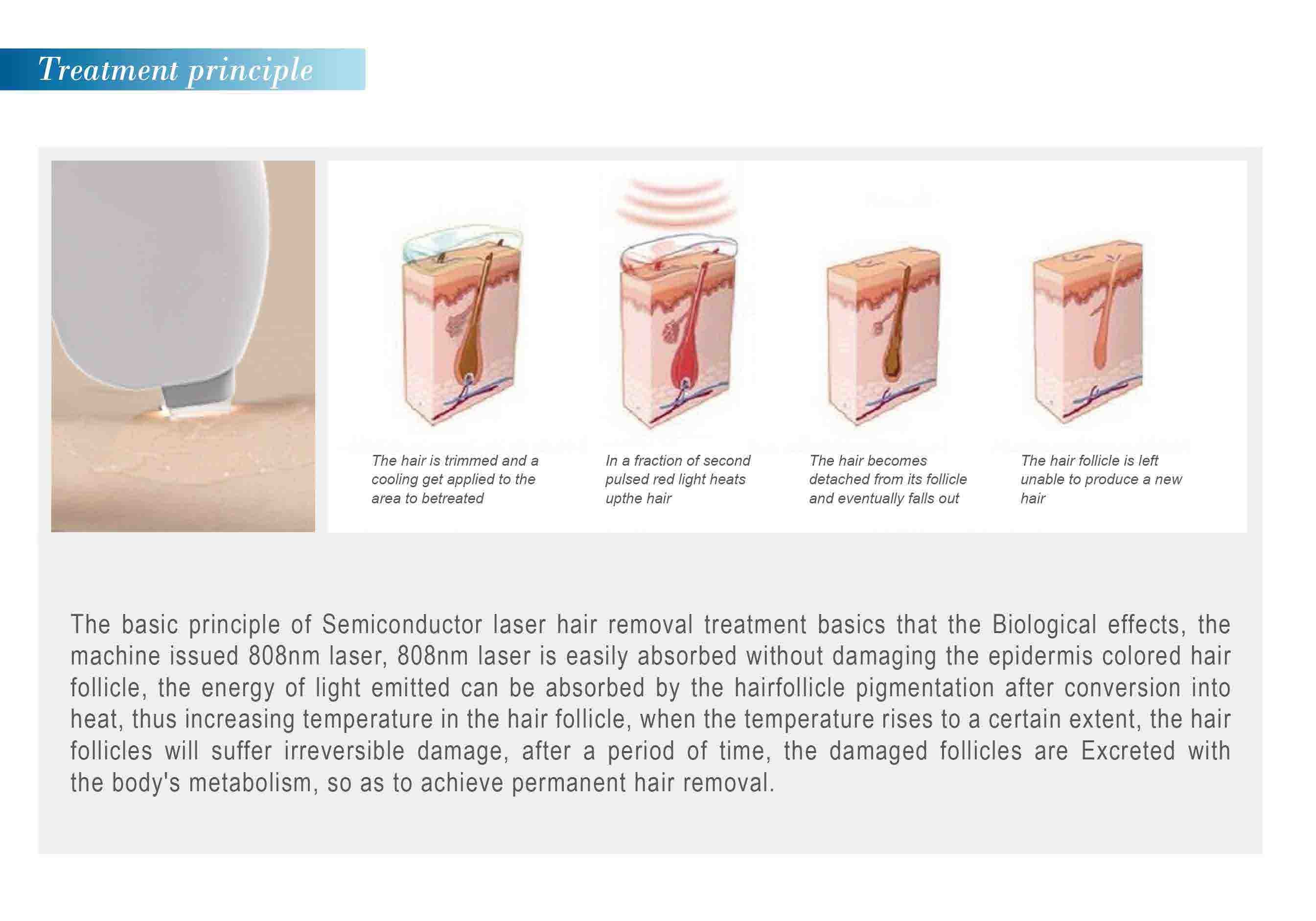 808 diode laser hair removal machine FDA approved laser hair removal machine
