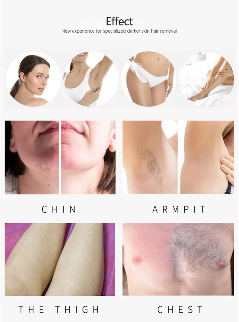 Portable Triple Wavelength Diode Laser , 100J Diode 808 Laser Hair Removal Machine