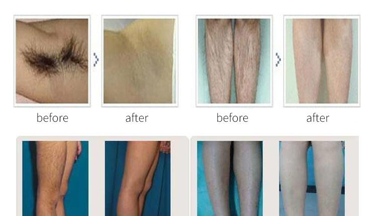 1000Mj ND YAG Laser Carbon Peel Machine 755nm 808nm 1064nm Diode Laser