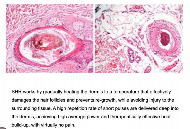 Multifunctional SHR IPL Machine Laser Hair Removal Skin Rejuvenation 10 Shots 1s Frequency