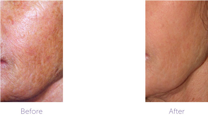 Carbon Dioxide CO2 Fractional Laser Machine For Skin Scar Treatment