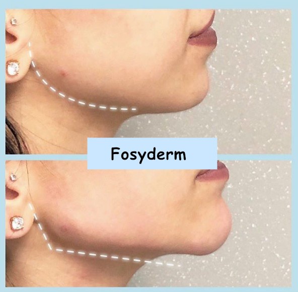 Fosyderm Deep Dermal Filler For Nose Chin HA Hyaluronic Acid