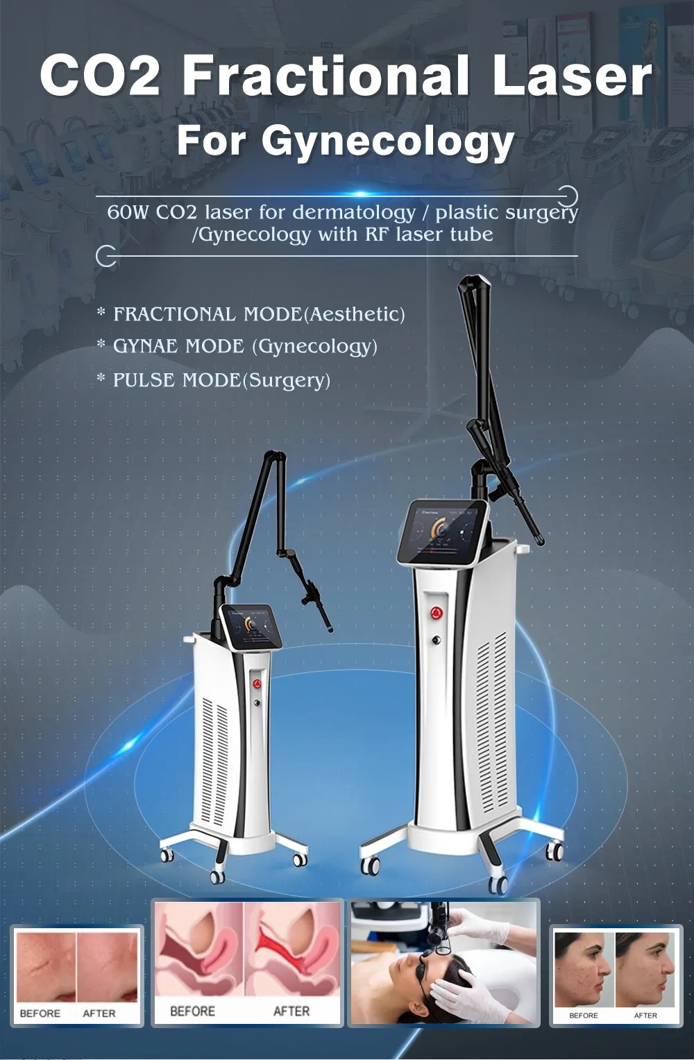 GOMECY 2024 Facial Skin Care Co2 Fractional Laser Stretch Mark Fractional Co2 Laser For Warts Scars Birthwarks Removal
