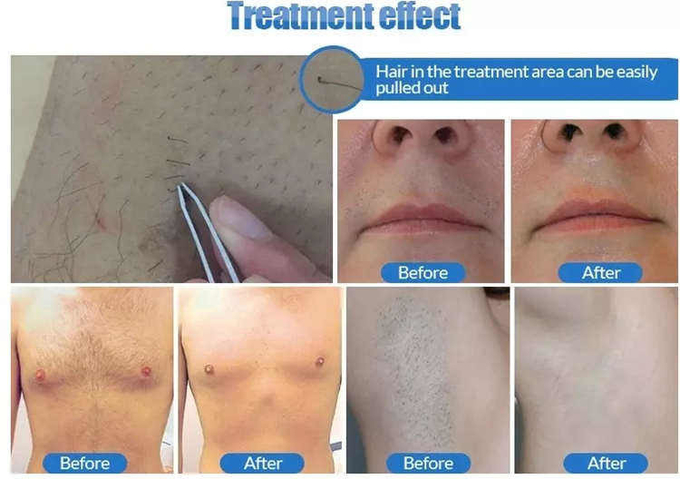 1200W Alma Laser Soprano Ice Platinum 808 Diode Laser Hair Removal Machine