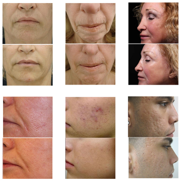 fractional rf microneedle-treatment.jpg