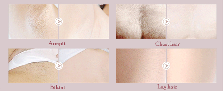Portable Laser Hair Removal Machine IPL Depilatory Instrument at Home