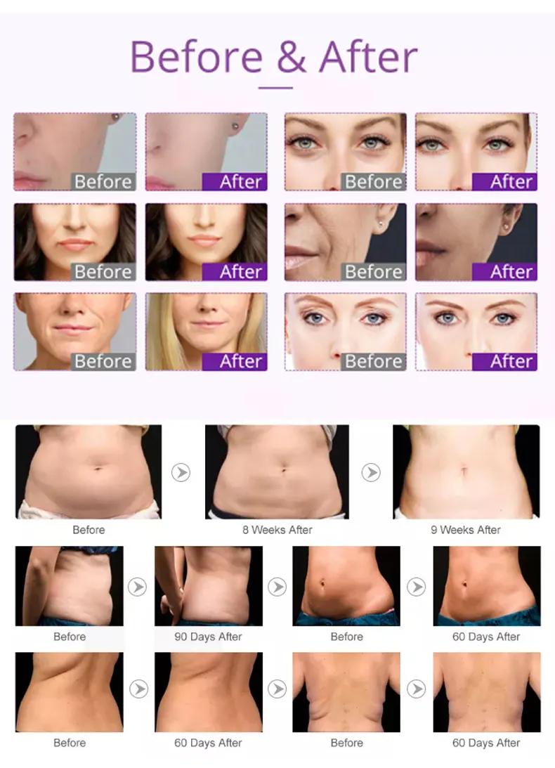 Ultrasound Cavitation Machines RF Cavitation Machine