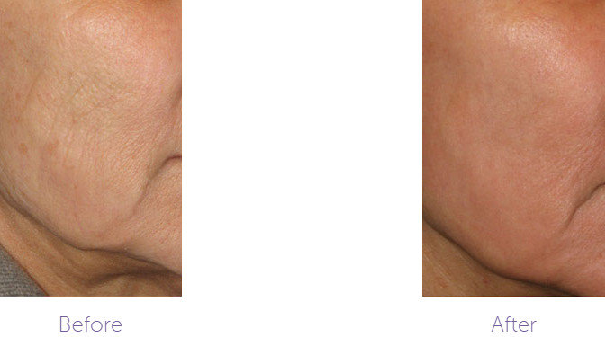 Carbon Dioxide CO2 Fractional Laser Machine For Skin Scar Treatment