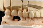 Multilayer Full Zirconia White Style With Layers High Translucency High