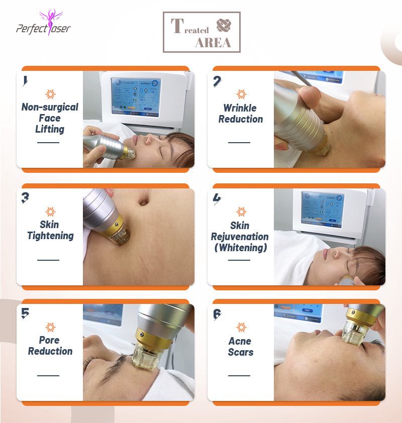 Skin Lifting RF Microneedling Machine Ance Stretch Marks Removal Machine