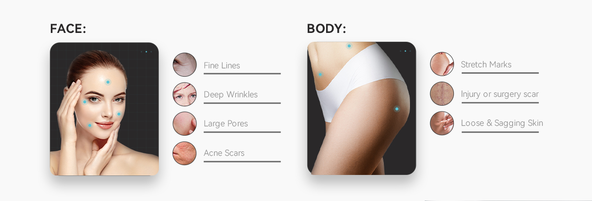 High Quality Acne Removal Microneedling Radio Frequency Rf Microneedling Vacuum Rf Microneedle Machine