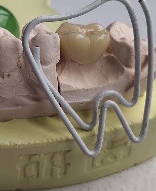 Temporary PMMA Temporary Crown
