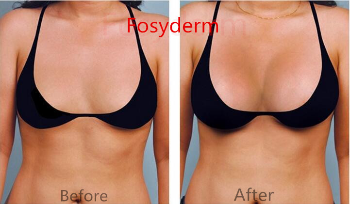 Hyaluronic Acid Breast Filler 10ml , Women Breast Augmentation Injection Filler