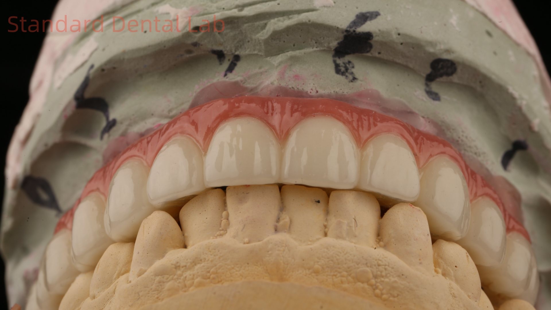 Hybrid Titanium Screw Retained Dental Implant Crown All On 4 Dental Implant Zirconia Bridge