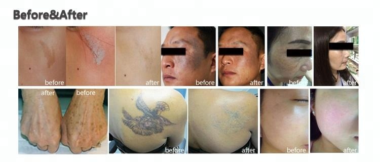 Oem Professional Picosecond Laser Removal Nd Yag Laser Picolaser Tattoo Removal Machine